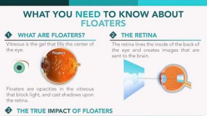 Floater Vitrectomy